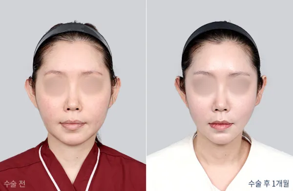 Before/After