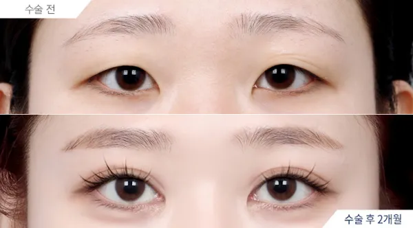 Before/After