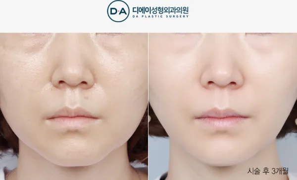 Before/After