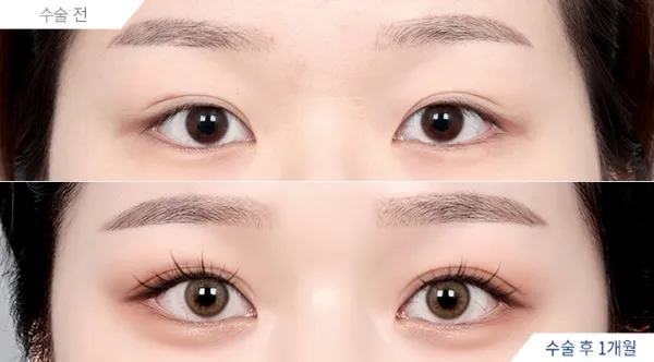 Before/After