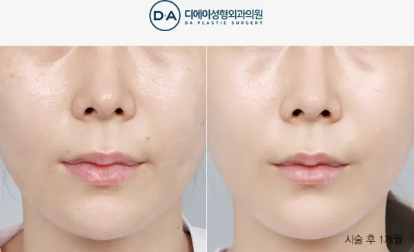 Before/After