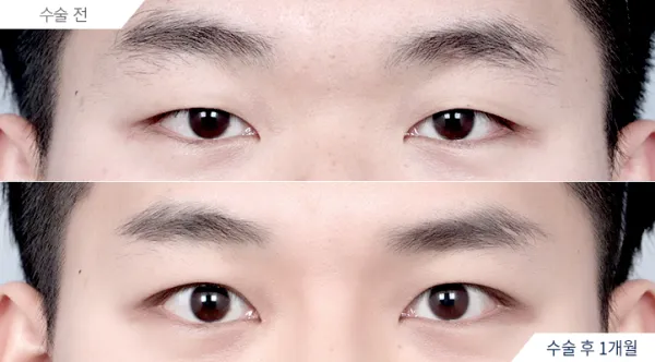 Before/After