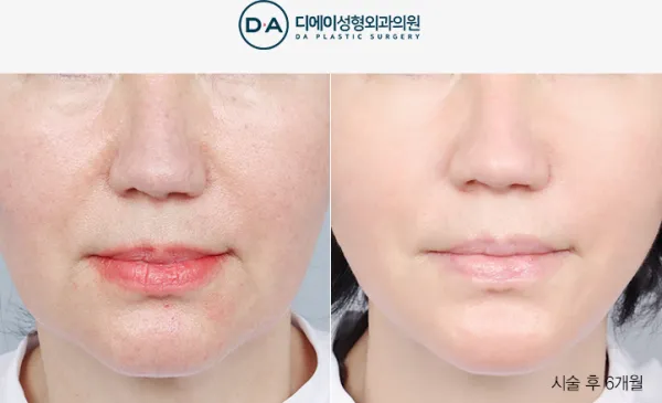 Before/After
