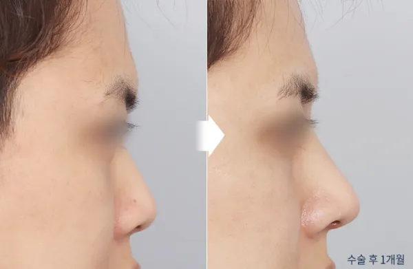 Before/After