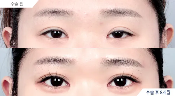 Before/After