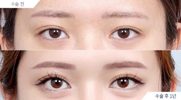 Before/After