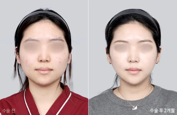 Before/After