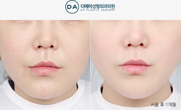 Before/After