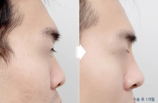Before/After