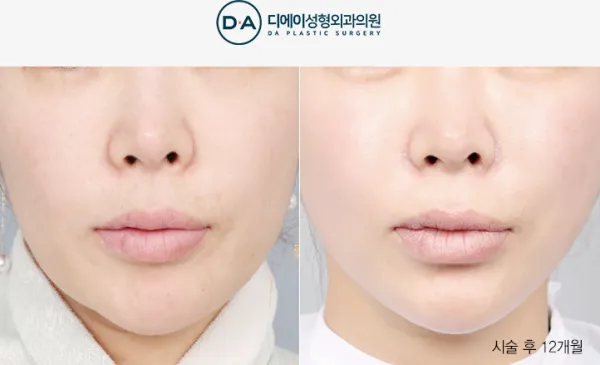 Before/After