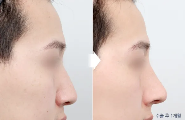 Before/After