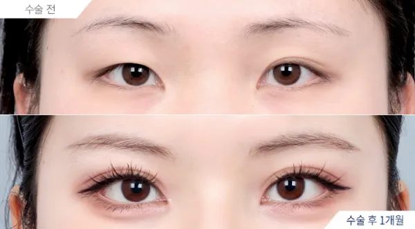 Before/After