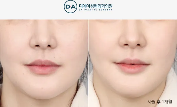 Before/After