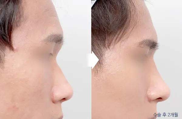 Before/After