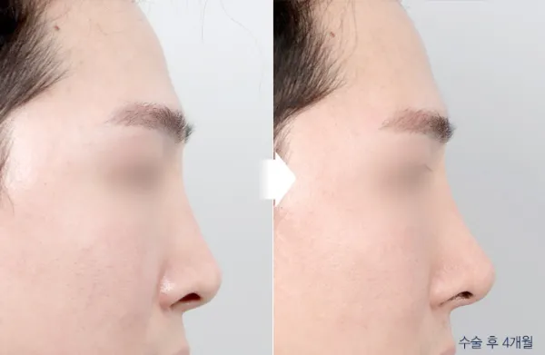 Before/After