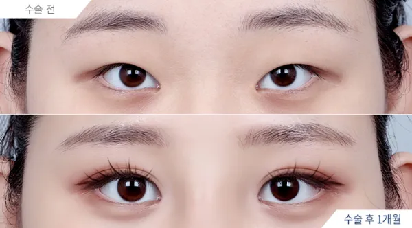 Before/After