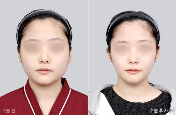 Before/After