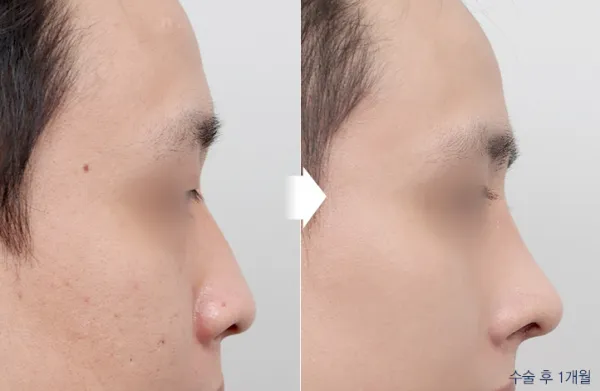 Before/After