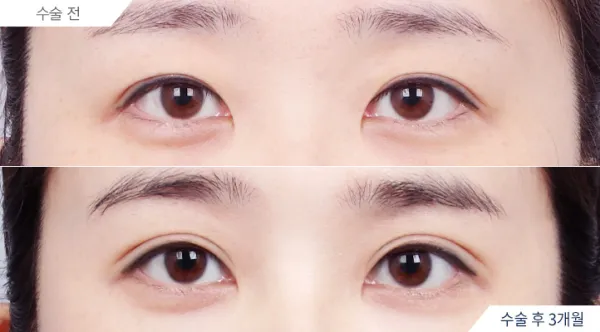 Before/After