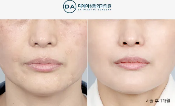 Before/After