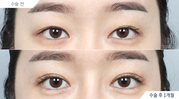 Before/After