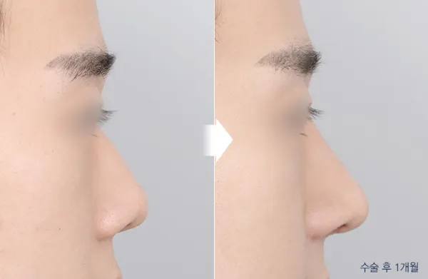 Before/After
