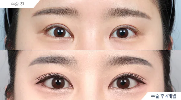 Before/After