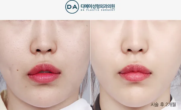 Before/After