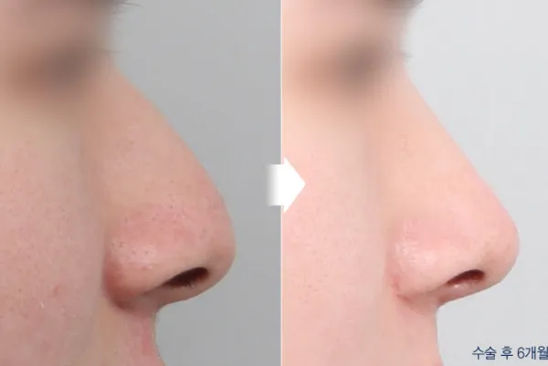 Before/After