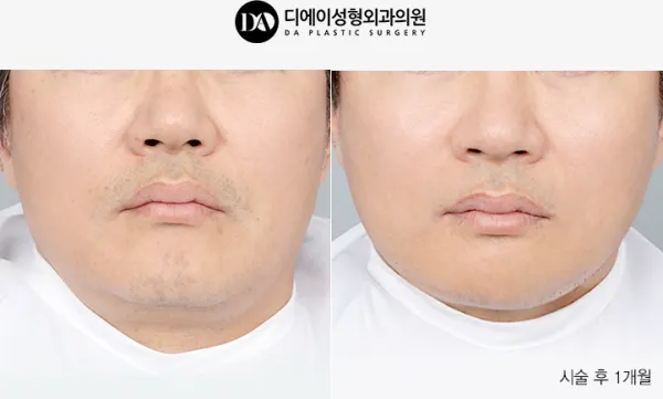 Before/After