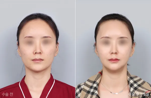 Before/After