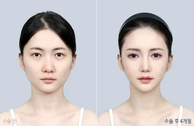 Before & After