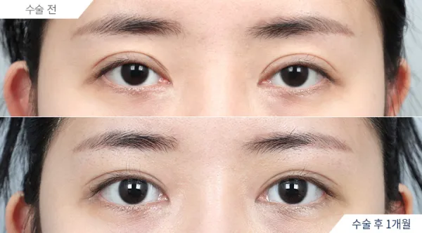 Before/After