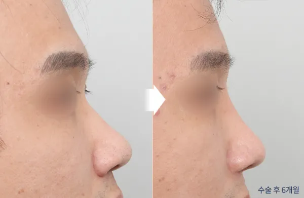 Before/After