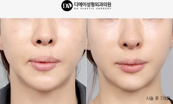 Before/After