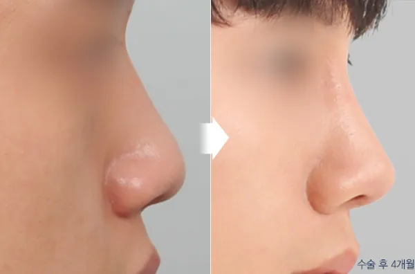 Before/After