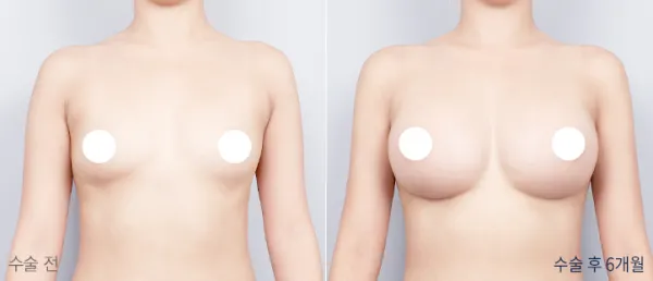 Before/After