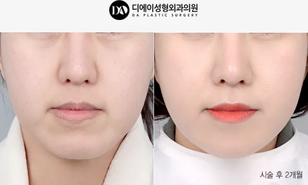 Before/After