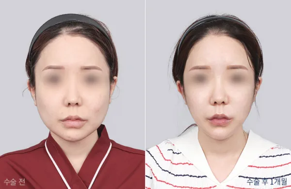 Before/After