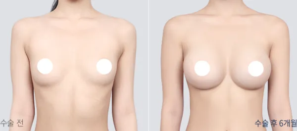 Before/After
