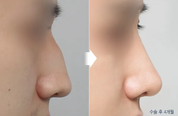 Before/After