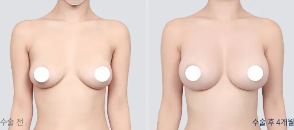 Before/After