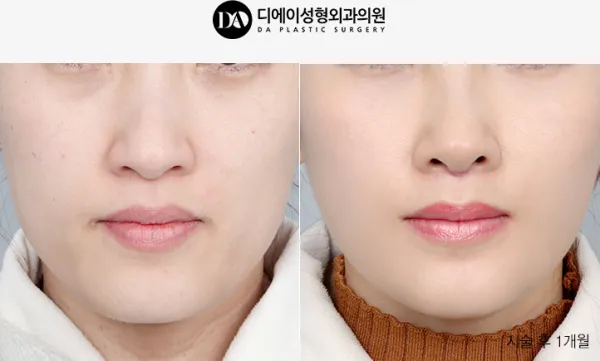 Before/After