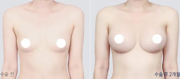 Before/After