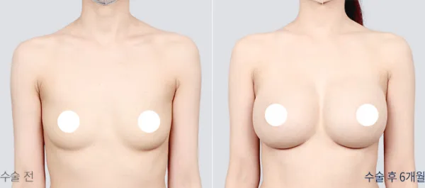 Before/After