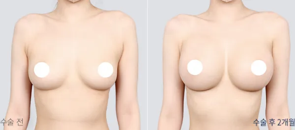 Before/After