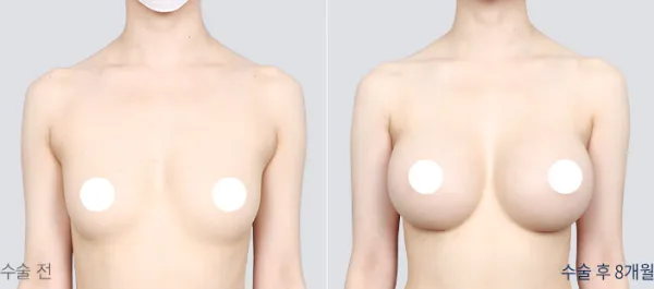 Before/After