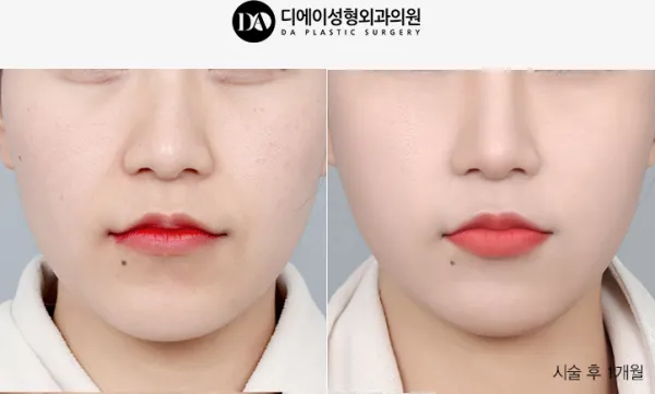 Before/After