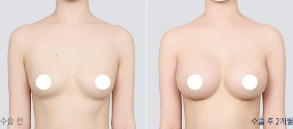 Before/After