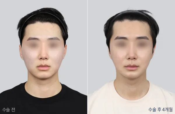 Before/After